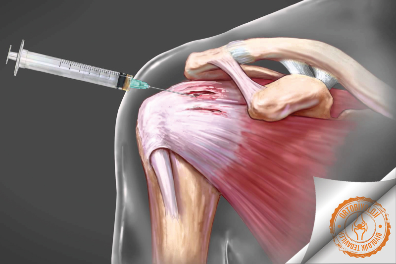 prp ile omuz tendon tedavisi ortobiyoloji