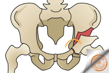 Kalça Osteotomisi